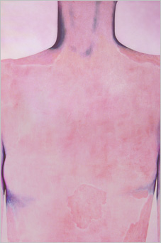 Pink man with red blotches II